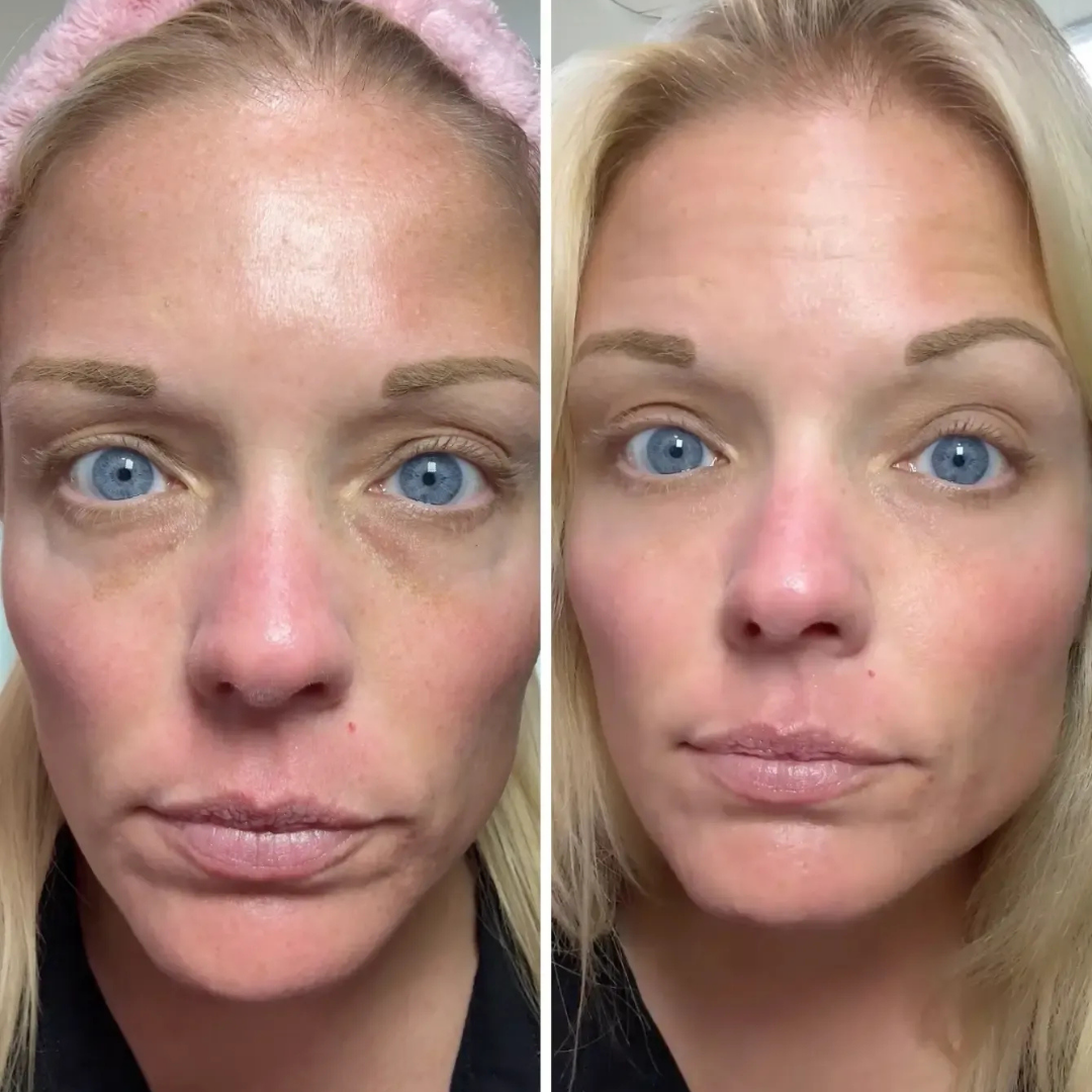 SKNDAILY™ - ALL IN ONE BALM FOR UNDER EYE RENEWAL